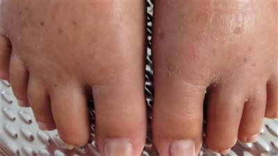 انتفاخ القدمين و احتباس السوائل في الجسم وكيف تتخلص منهم بطرق طبيعيه بدون ادويه