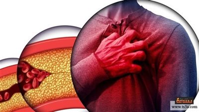 علاج اڼسداد الشرايين بمجموعة نصائح وطرق منزلية