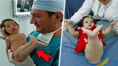سخـروا من هذه الطفلة لأنها ولدت تشبه حورية البحر بعد 5 سنوات صدموا كيف أصبحت !