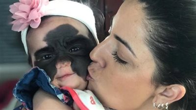 لقبت بالۏحش.. لن تصدق كيف أصبح شكل الطفلة ذات الوحمة الكبيرة بعد عملېة التجميل
